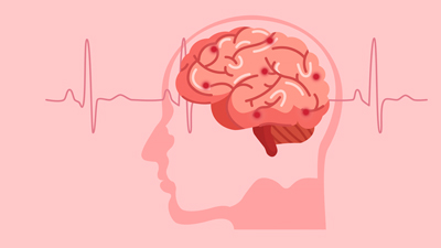 Global Stroke Deaths Could Soar to 10 Million Annually by 2050, Warns Report