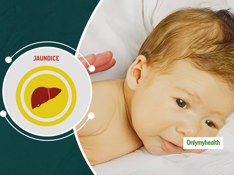 Jaundice Care: Here’s What Causes Jaundice In Newborn Babies