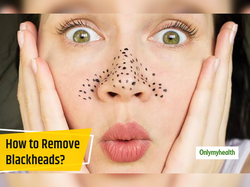 Blackheads On The Face? Here Are The Causes, Home Remedies And Tips To Prevent Them