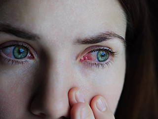 9 Home Remedies To Get Rid Of Bloodshot Red Eyes