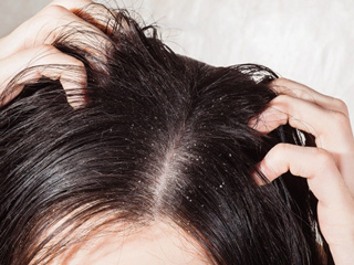 8 Amazing Home Remedies To Get Rid Of Flaky Scalp In Winters