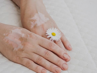 White Spots On Skin? Here Are 9 Effective Home Remedies To Get Rid Of Them