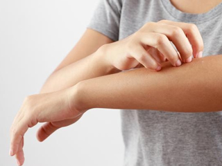  8 Natural Ways To Prevent Psoriasis 