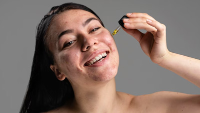 Fighting Acne: Benefits Of DIY Serums And How To Make It 