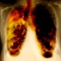 Types of Lung Cancer