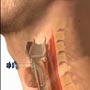 What is Throat Cancer?