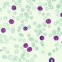 About Acute Lymphocytic Leukaemia