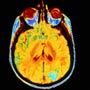 Causes of Brain Cancer Recurrence