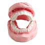 Dental Bridges: Pros and Cons
