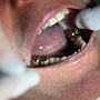 Tooth Filling Options