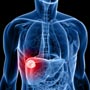 Breakthrough in Treatment for Chronic Liver Disease
