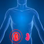 Kidney Cancer Stages