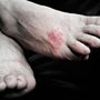 Causes of Diabetic Blisters