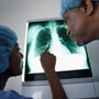 Tips to Prevent Carcinoid Tumours of the Lung