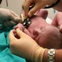 Congenital Heart Defects in Newborns