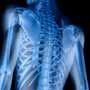 What is Bone Marrow Transplant Used for?