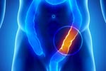 Treatment of Colorectal Cancer