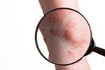 What are the Risks Associated with Skin Cancer?
