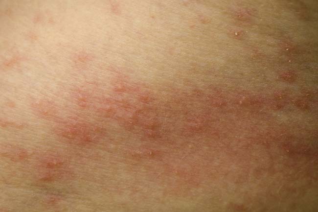 Does Gonorrhea Cause Skin Rash