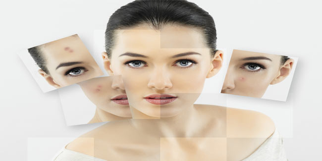 Causes of Acne Vulgaris