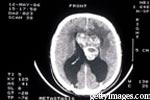 What are the prognoses for metastatic bone cancer?