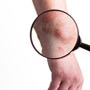 What are the various types of Skin Cancer?