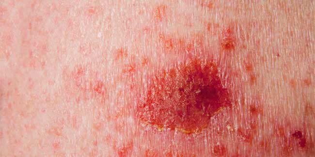 What is Lyme Disease?
