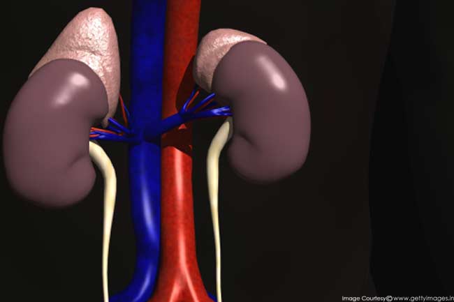 Kidney Stones