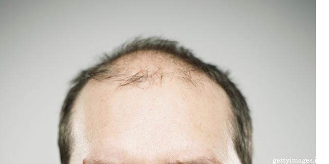 Men who Bald Early are at Risk of Incurable Lou Gehrig's Disease