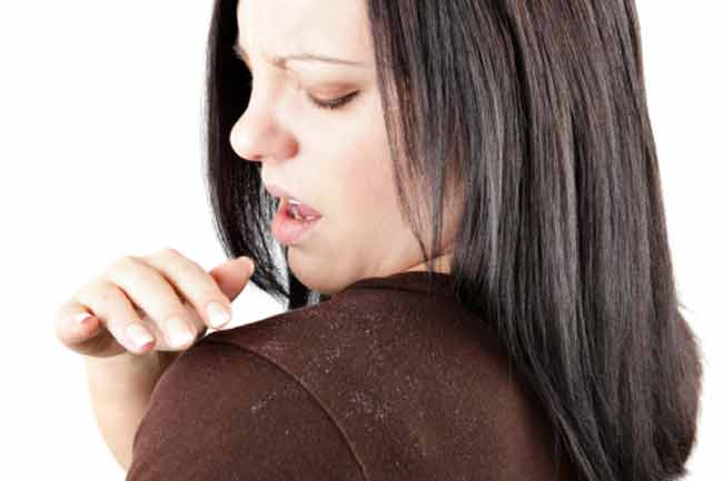 Remedy for Dandruff
