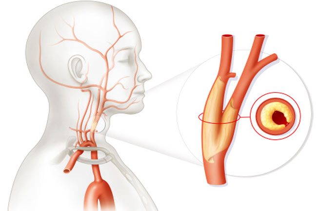 कैरोटिड धमनी रोग (Carotid Artery Disease)
