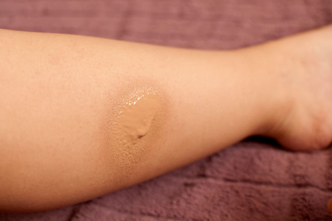क्रोनिक वीनस इनसफिसिऐंशी (Chronic Venous Insufficiency)
