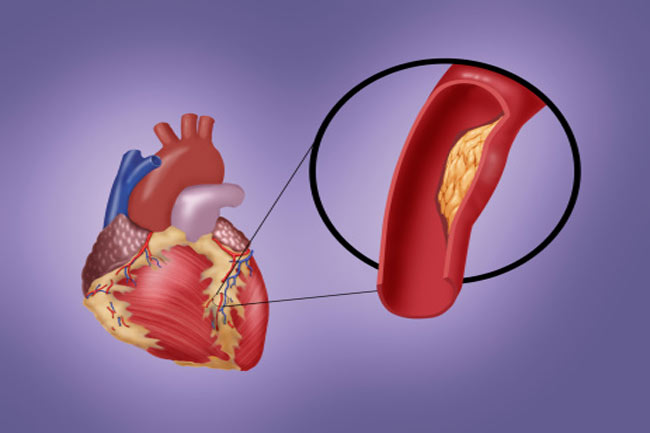 9-artery-and-vein-diseases-to-avoid-in-hindi-9