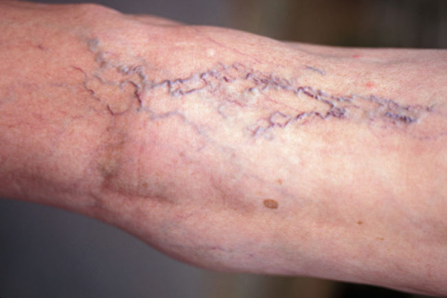वैरीकोज वेन्स (Varicose Veins)