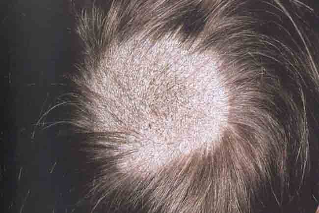 टियना केपिटिस (Tinea Capitis)