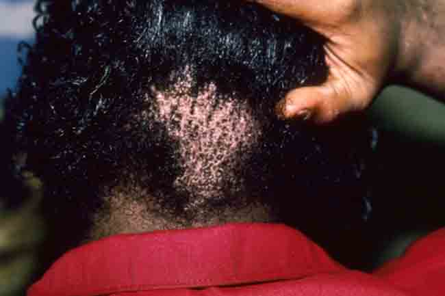 एलोपेसिया एरीटा (Alopecia Areata)