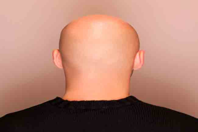 एलोपेसिया यूनिवर्सालिस (Alopecia Universalis)