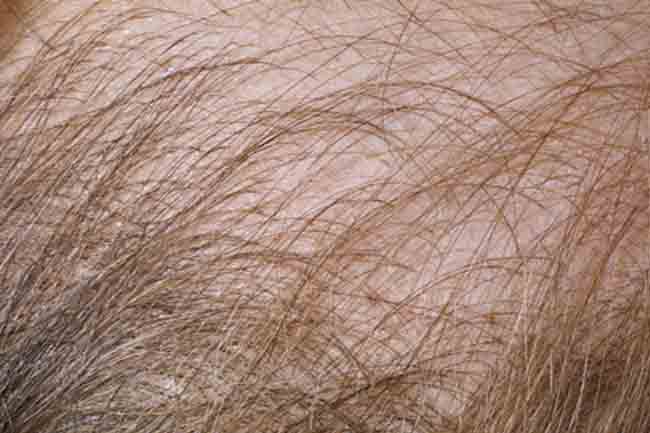 एंड्रोजेनिक एलोपेसिया (Androgenic Alopecia)