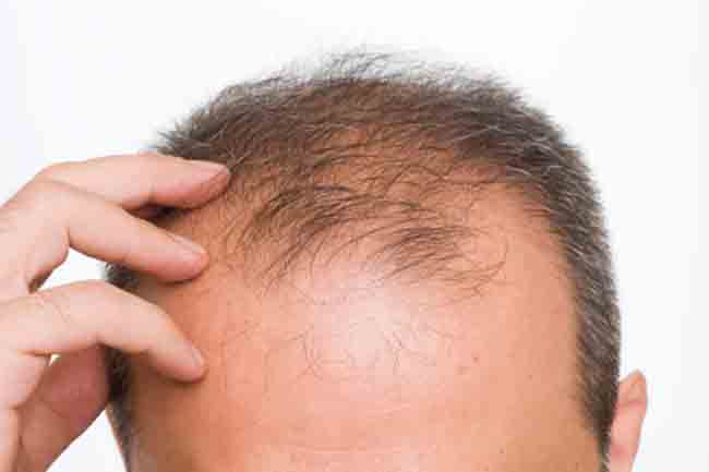 टेलोजन इफ्लूवियम (Telogen Effluvium)