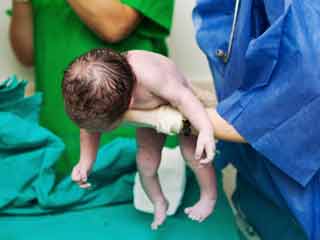 Delayed Cutting of Umbilical Cord Healthy for Newborn