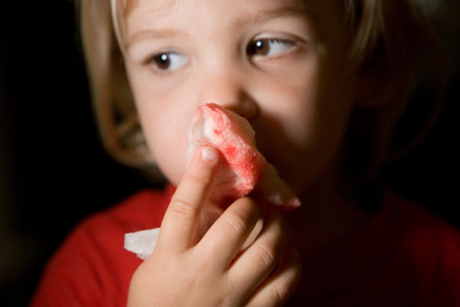 Nosebleed Causes