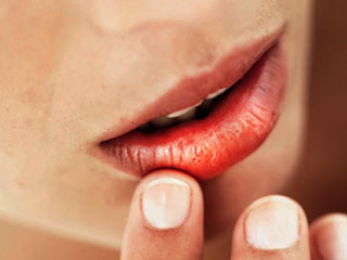 What is Cheilosis? Other Diseases