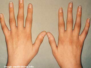 रयूमेटायड अर्थराइटिस की चिकित्&zwj;सा