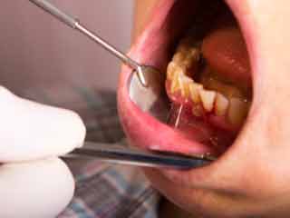 Connection between Periodontal Diseases and Other Health Conditions