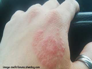 रयूमेटायड अर्थराइटिस और दर्द