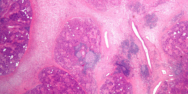 What is the prognosis of Sialadenitis?