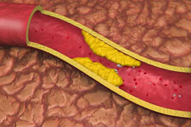 Plaque Ruptures