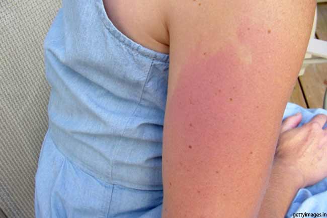 Red Scaly Skin in Light-exposed Areas