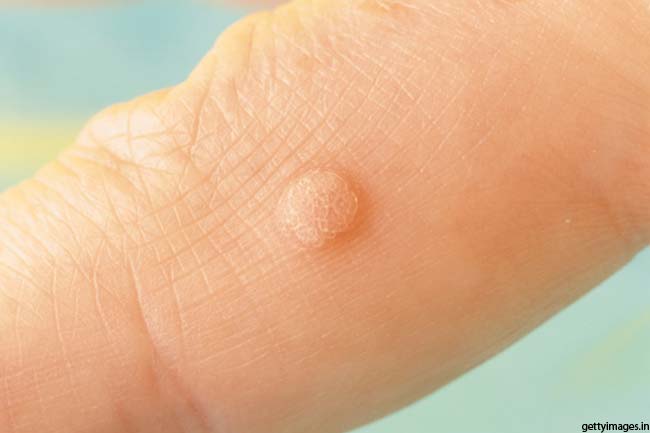 10 Home Remedies For Warts Treat Warts Naturally Home Remedies 