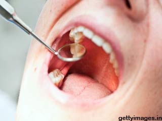 कैविटी क्या है और इससे कैसे बचें